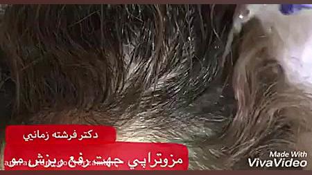 رفع ریزش مو با انجام مزوتراپی و میکرونیدلینگ TWA
