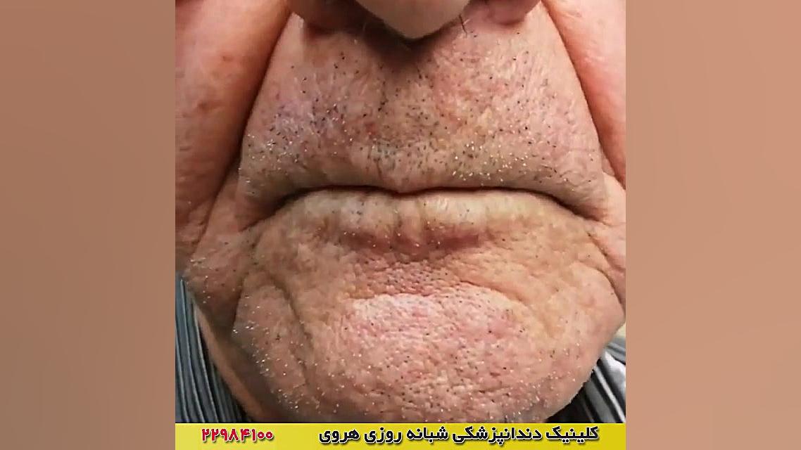 دندان مصنوعی پر کردن دندان