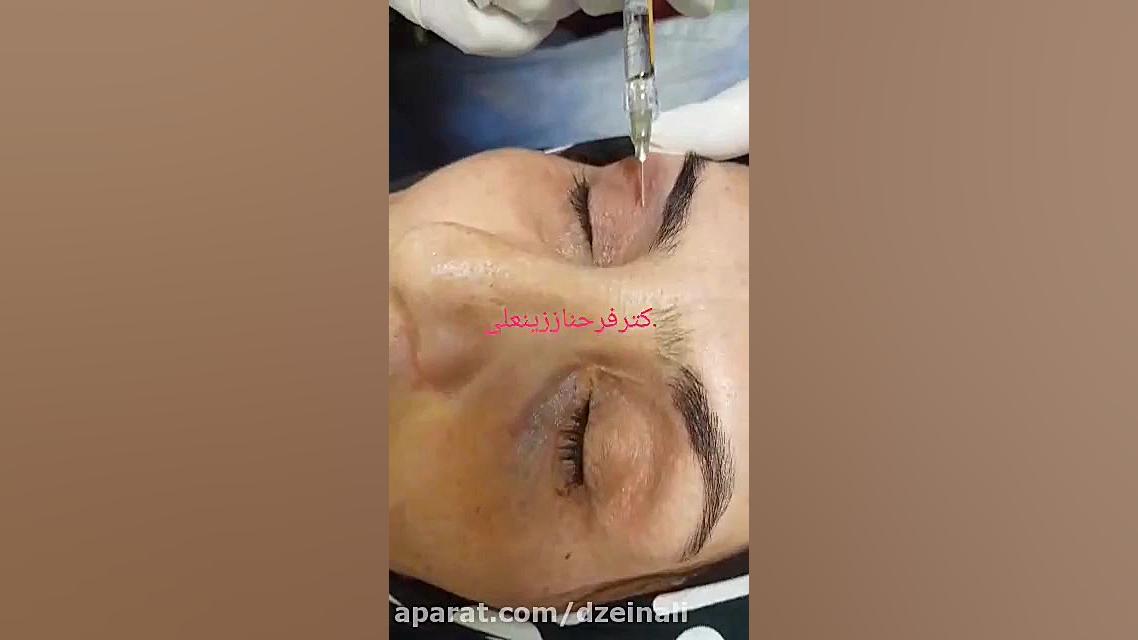 پر کردن و جوانسازی دور چشم با تزریق فیلر سوئیسی بلترو دکتر فرحناز زینعلی - متخصص پوست، مو، زیبایی زنجان