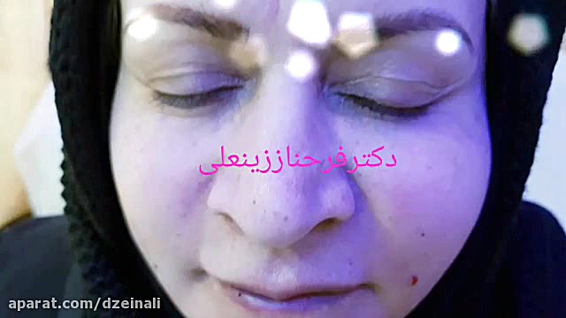 ساکشن چربی از شکم وتزریق آن به صورت دکتر فرحناز زینعلی - متخصص پوست، مو، زیبایی زنجان