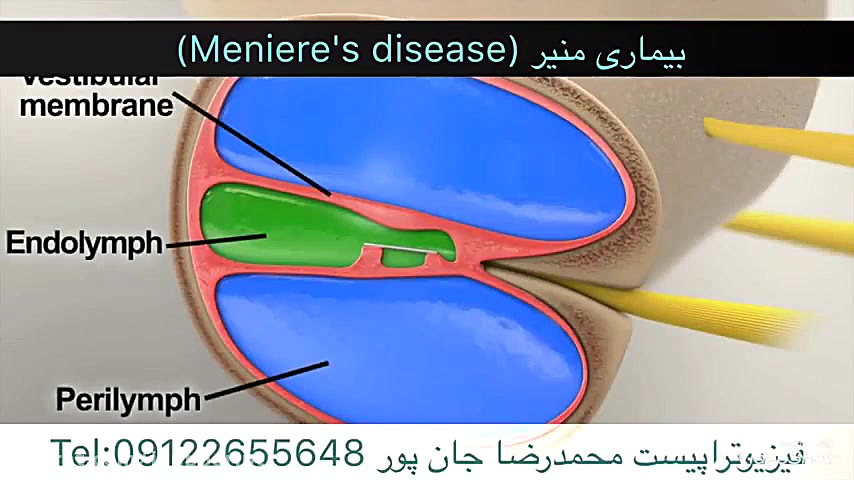 بیماری منیر (Meniere's disease). فیزیوتراپی09122655648 لیپوساکشن