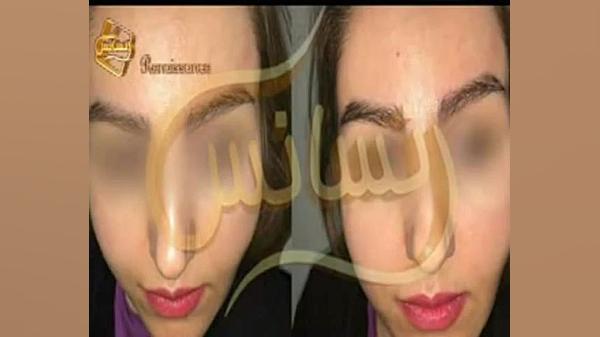 فیلم کاشت ابرو طبیعی با روش SUT مرکز کاشت مو لیدی گاگا