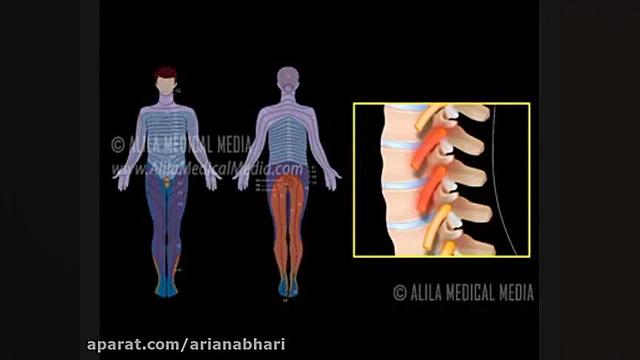 درمان دردهای تیرکشنده کمر با بلوک عصبی و بدون برش جراحی کاشت مو