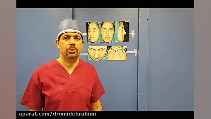 نمونه کار جراحی بینی گوشتی قوزدار از بهترین جراح بینی دکتر امید ابراهیمی