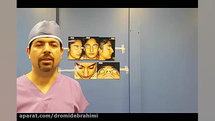 نمونه کار جراحی بینی گوشتی قوزدار از بهترین جراح بینی دکتر امید ابراهیمی
