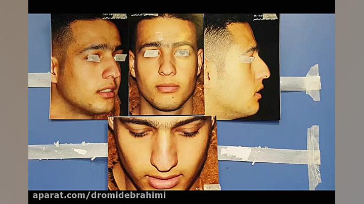 نمونه کار جراحی بینی گوشتی و قوزدار از بهترین جراح بینی دکتر امید ابراهیمی