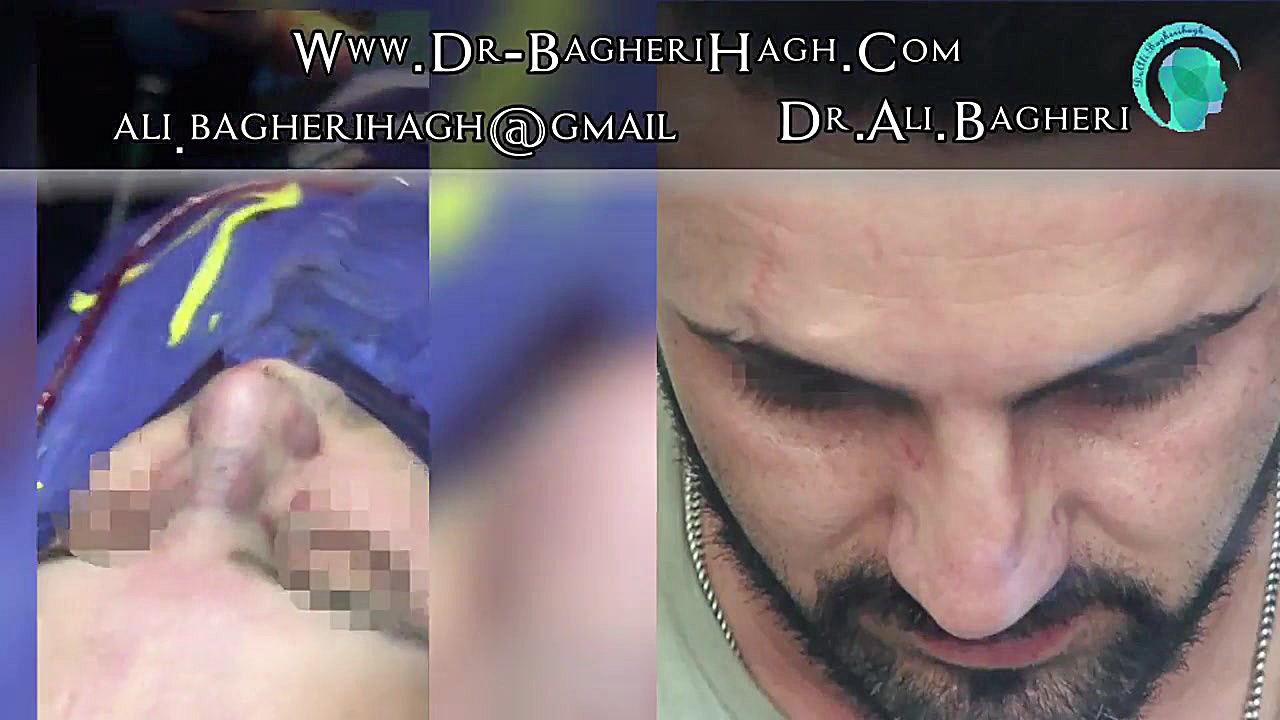 جراحی بینی ، دکتر علی باقری حق دکتر علی باقری حق