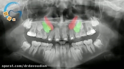 هدایت نیش نهفته در ارتودنسی |...