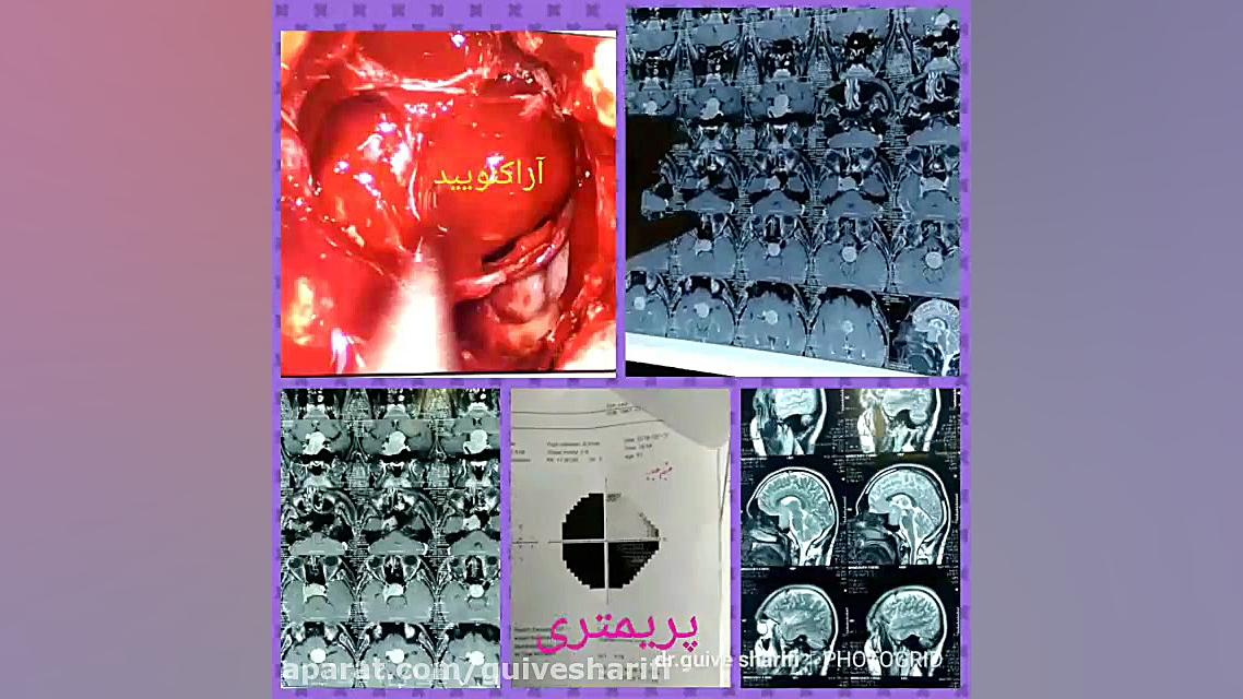65.تومور آدنوم هیپوفیز کلینیک لیزر