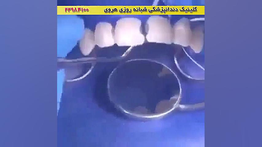 ترمیم و پرکردگی حفره دندان رادیوگرافی دندان