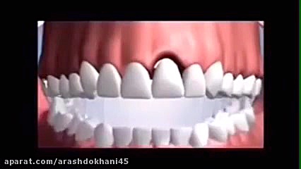 تصاویری از بهم ریختن نظم تمامی دندانها باکشیدن یک دندان دکتر آرش دخانی