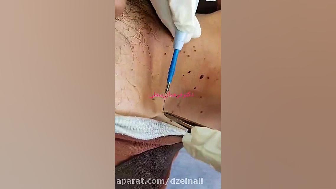 جراحی الکتریکی فیبرومای متعدد پوست در یک جلسه دکتر فرحناز زینعلی - متخصص پوست، مو، زیبایی زنجان