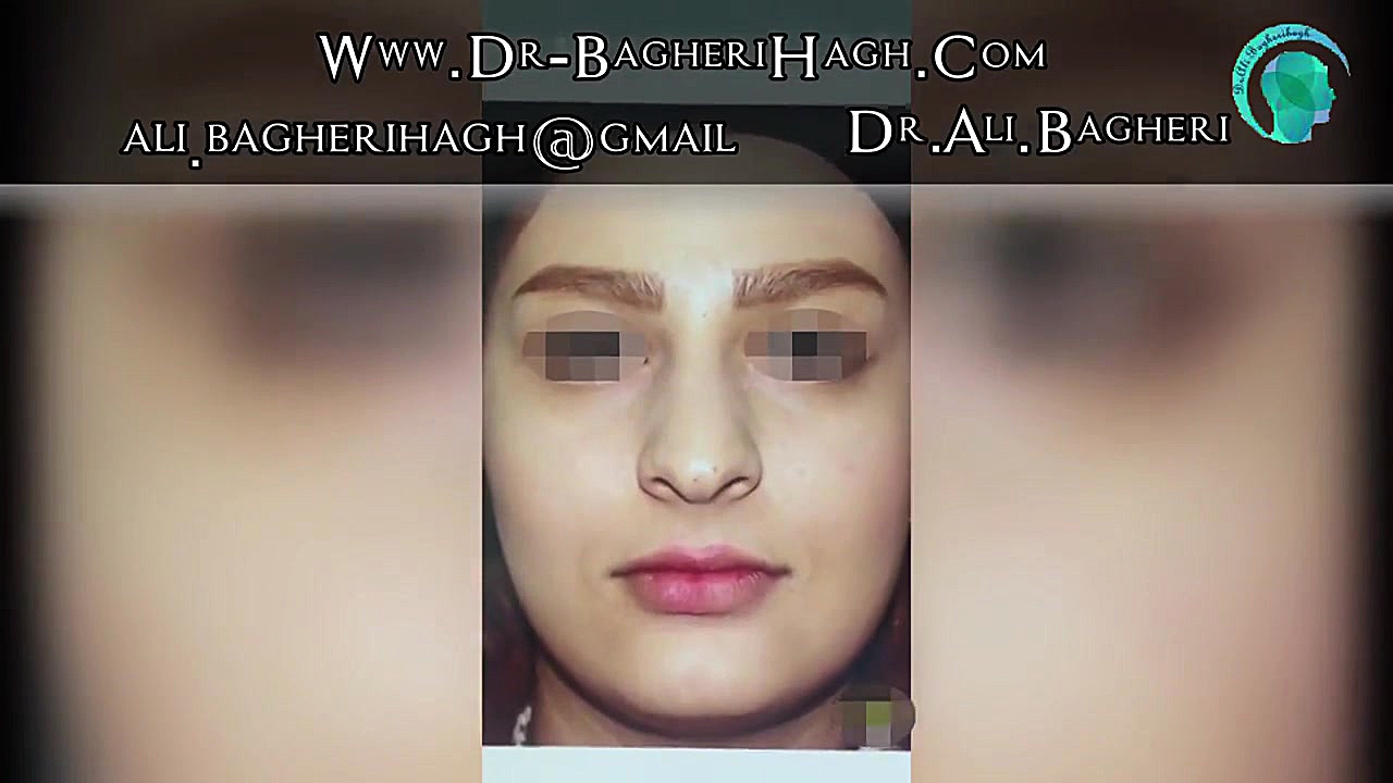 نمونه جراحی بینی دکتر علی باقری حق دکتر علی باقری حق