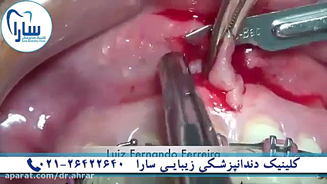 اصلاح خط لبخند کاپوت سکودانئوم
