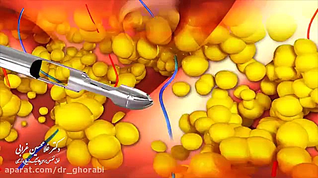 تخلیه چربی و لیپوساکشن هایپررفلکسی