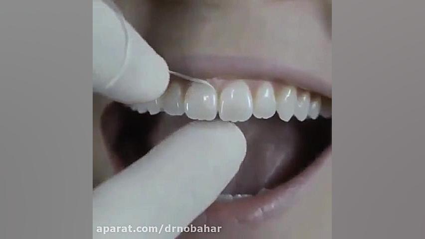 آموزش نخ دندان کشیدن صحیح دکتر شکوفه نوبهار