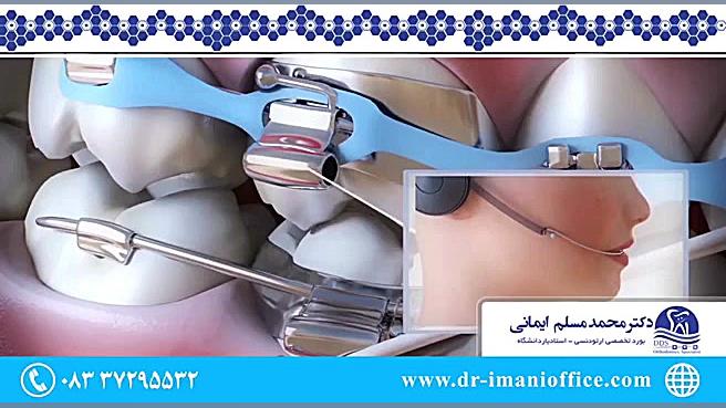 نحوه قراردادن براکت ها و تنظیم دندان ها در ارتودنسی دکتر محمد مسلم ایمانی - متخصص ارتودنسی در کرمانشاه