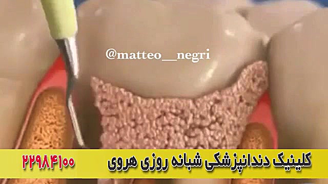 جرمگیری و درمان بیماری لثه وزارتان