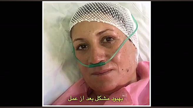 درمان بیماری همی فاسیال اسپاسم جنیفر لوپز