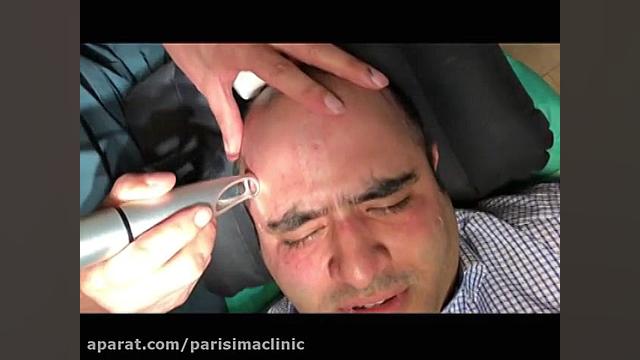 جوانسازی و از بین بردن لک صورت - 22807060 کاشت ریش