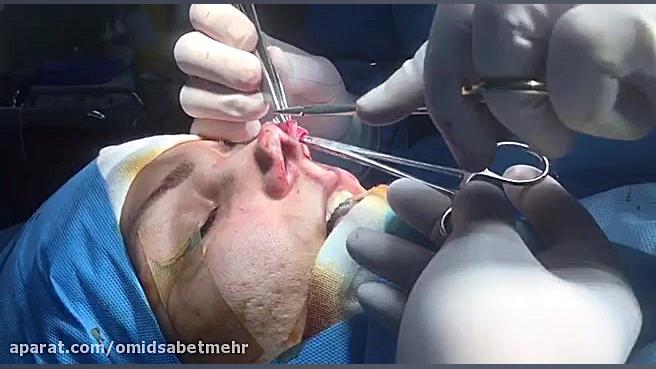 جراحی بینی گوشتی و گذاشتن غضروف طبیعی لباس اگزواسکلتون پزشکی