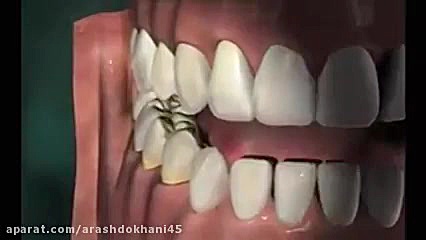 روکش دندان هایپوپاراتیروئیدیسم