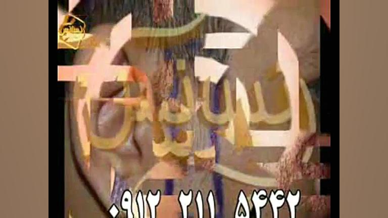 کاشت ریش و سبیل به روش SUT مرکز مو رنسانس FEV1