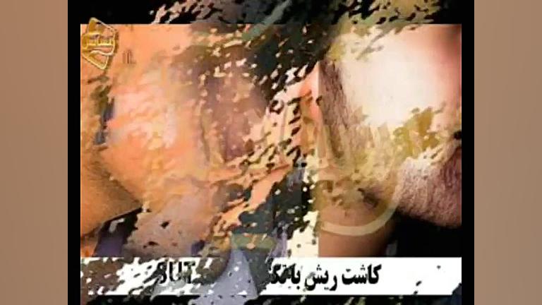 کاشت ریش و سبیل به روش SUT مرکز مو رنسانس پیلینگ